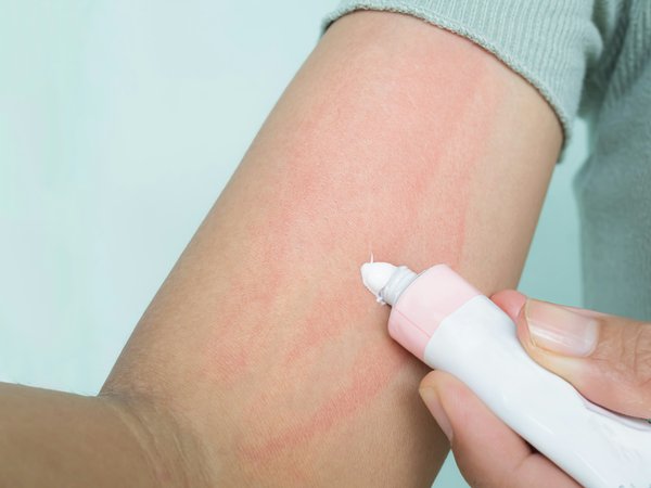 Eczéma des mains : solutions simples pour une peau apaisée