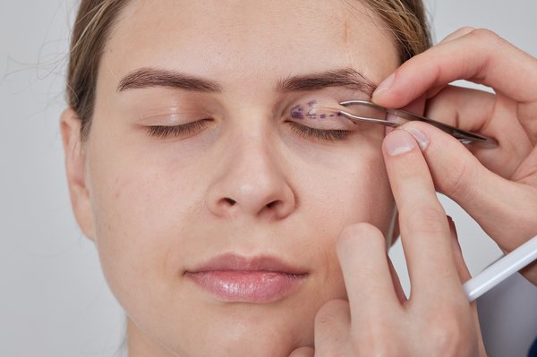 Renaissance du regard : tout savoir sur la blépharoplastie supérieure